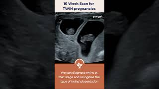 10 Week Scan for Twins [upl. by Elbert443]