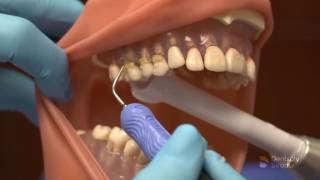 Cavitron FSI 10  Dentsply Sirona [upl. by Rheinlander]