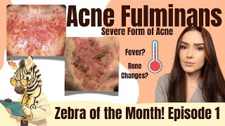 Acne Fulminans  A Severe Acne Variant  Zebra of the Month [upl. by Py]