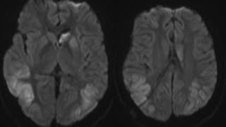 Case discussion Transient PostIctal MRI changes [upl. by Schreibe]