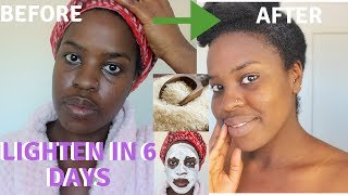 How I How i BRIGHTENED MY SKIN IN 6 DAYS REALISTIC and Natural way to reduce hyperpigmentation [upl. by Ahmad220]