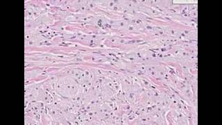 Histopathology SkinGranular cell tumor [upl. by Brasca746]