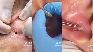 Ultimate ASMR Pimple Popping amp Blackhead Removal  Relaxation amp Satisfaction Guaranteed 🧖‍♀️ [upl. by Habeh87]