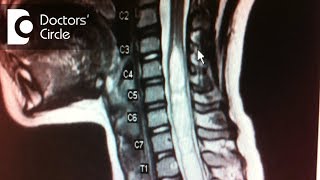 How to manage Syringomyelia in 45 year old  Dr Mohan M R [upl. by Llennoj291]