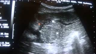 ultrasound HEPATOMA and its location [upl. by Olenolin]