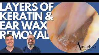 LAYERS OF KERATIN amp EAR WAX REMOVAL  EP886 [upl. by Rolo]