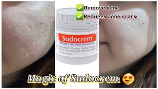 Sudocrem for acne  How to use sudocrem amp its benefits  One skincare solution [upl. by Zahavi529]