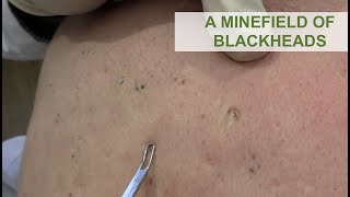 A Minefield of Blackheads  Dr Derm [upl. by Dnalevets]