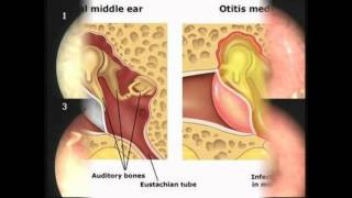 MYRINGOTOMY OF BULLOUS MYRINGITIS [upl. by Sandye]