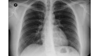 Chest xray Eventration of Diaphragm [upl. by Abla]