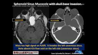 Sphenoid Sinus Mucous Retention Cyst vs Mucocele [upl. by Dorej]