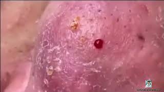 Ultimate Pimple Popping 2024 Painful Acne Solutions [upl. by Ignatzia]