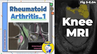 Fig 5E04 Rheumatoid Arthritis  Erosion and Synovitis [upl. by Nodnab]