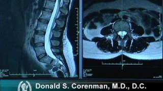 How to Read a MRI of the Normal Lumbar Spine  LowerBack  Vail Spine Specialist [upl. by Grubman330]