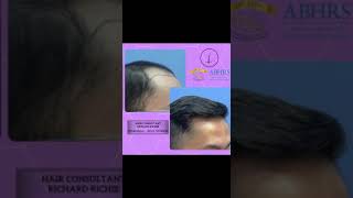 iPlus™️ FUE Hair Transplant  Great transformation after hair transplant  Klinik Dr Inder [upl. by Atteuqaj]