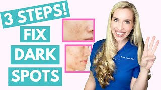 Acne Dark Spots  हिंदी  How to treat  serum cream recommendations  Dermatologist  Dr Aanchal [upl. by Adnohs199]