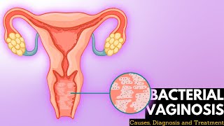 Bacterial vaginosis Causes Signs and Symptoms DIagnosis and Treatment [upl. by Eivi577]