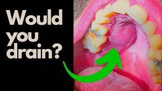 Tooth Abscess  Would you INCISE and Drain this Abcess [upl. by Suriaj24]