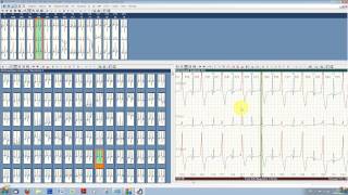 Typcial ECG analysis with ECGpro Holter 743 [upl. by Woody]