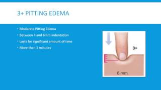 Pitting Edema Grading Scale 4 Levels [upl. by Kcirevam270]