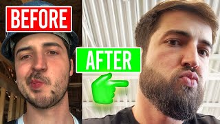 Ultimate Beard Growth Guide Minoxidil amp MicroNeedling [upl. by Gaudette]