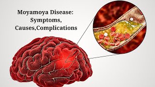 Moyamoya Disease Understanding Symptoms Causes and Complications  Holistic Health TV [upl. by Alegnad965]