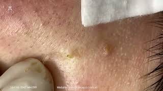 Big Cystic Acne Blackheads Extraction Blackheads amp Milia Whiteheads Removal Pimple Popping [upl. by Asserak]