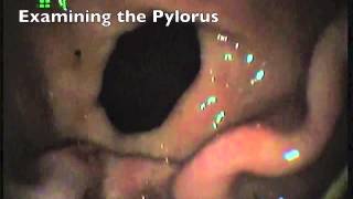 Equine Gastroscopy  Grade 3 Ulceration [upl. by Jesus]