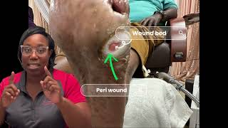 Diabetic Foot Ulcer Debridement Wound bed amp Peri wound explained👣🗣️‼️ [upl. by Pauli]