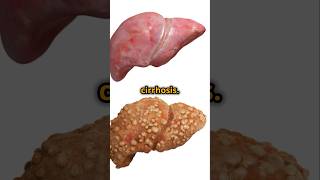 Top Causes of Liver Cirrhosis You Should Know shortvideo shortsviral shorts [upl. by Pris]