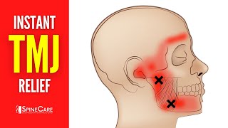 How to Relieve TMJ Pain at Home  30 SECOND RELIEF [upl. by Atinomar753]