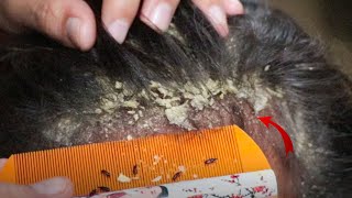 Removed Hundred of Lice From Head and Dry Scalp Huge Dandruff of Flakes Removal With Comb  1765 [upl. by Essyle]