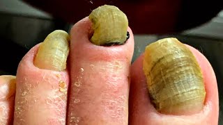 Toenail Cutting on Thick Crunchy Layered Nails  Dr Kim Kim Foot and Ankle [upl. by Htidirrem]