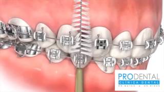 ¿Cómo lavarse correctamente los dientes con brackets [upl. by Valencia]