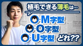 どの薄毛タイプが自毛植毛おすすめ？？？ハミルトン分類┃海外植毛の窓口®（南国マレーシア植毛で薄毛・AGA治療） [upl. by Neelyk]