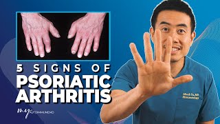 5 Signs of Psoriatic Arthritis How to know if you have psoriatic arthritis  Dr Micah Yu [upl. by Reywas]