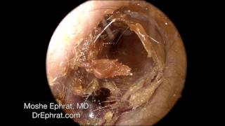 Ear Wax Removal [upl. by Rudin]