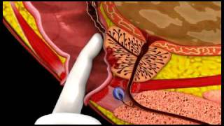 Prostate Cancer  3D Medical Animation  ABP © [upl. by Nillad]