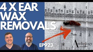 4 x EAR WAX REMOVALS INC BIG EAR WAX PLUG  EP923 [upl. by Marita]