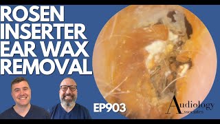 ROSEN INSERTER EAR WAX REMOVAL amp OTHERS  EP903 [upl. by Cutlor845]