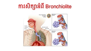 ការសិក្សាអំពីជំងឺ Bronchiolite [upl. by Eigram987]