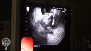 Endoscopic Ultrasound [upl. by Kersten207]