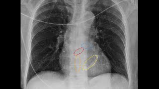 Calcificação do anel mitral [upl. by Lemor]