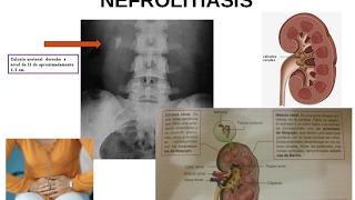 FISIOPATOLOGÍA URINARIA Litiasis renal o nefrolitiasis piedras en el riñón [upl. by Charita]