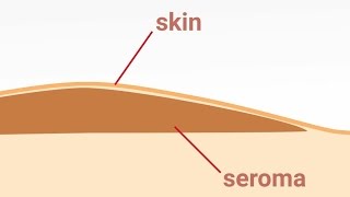 Seromul si indepartarea lui  Removal of postoperative Seromas [upl. by Dorthea]