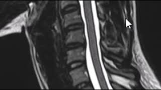 How to read and MRI of the cervical spine  First Look MRI [upl. by Aliac]