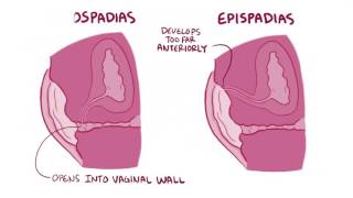 Hypospadias amp epispadias causes symptoms diagnosis treatment pathology [upl. by Anaej]