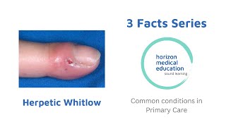 Herpetic whitlow  Finger infections  painful red finger  3facts [upl. by Sondra203]