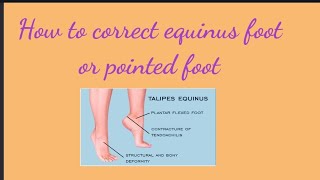 How to correct Equinus foot or pointed foot  Pinoy Physical Therapy [upl. by Shama]