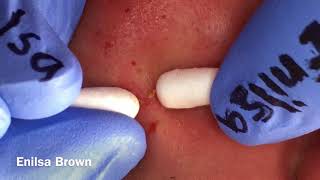 Blackheads Extractions on Christian Part 2 b [upl. by Eetsirhc]